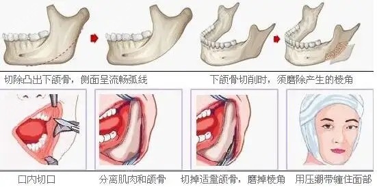 下颌角削骨瘦脸手术原理图