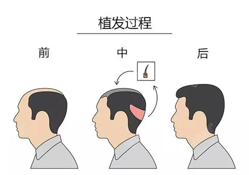 FUE、微针、不剃发植发多少钱一个单位  