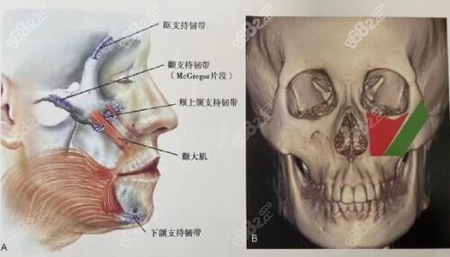 柳超颧骨手术技术优势