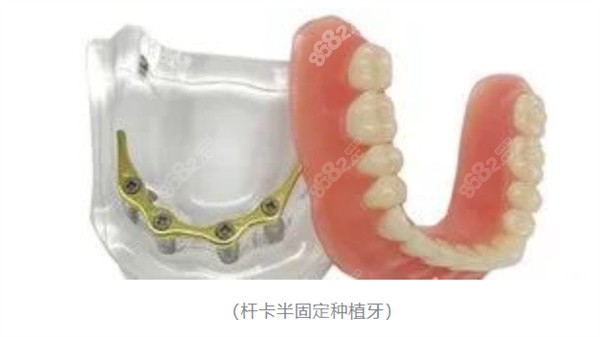 什么是杆卡半固定种植牙