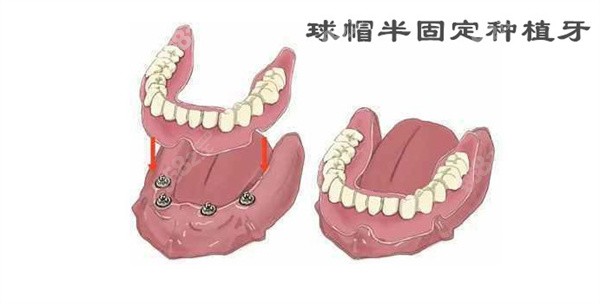 什么是球帽半固定种植牙