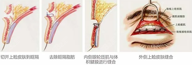 双眼皮手术图示