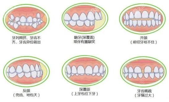 星迈口腔牙齿矫正适应类型