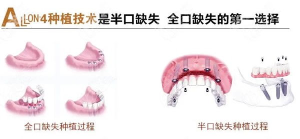 all-on-4半口或全口种植牙怎么样
