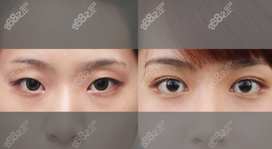 韩国原辰医院双眼皮手术