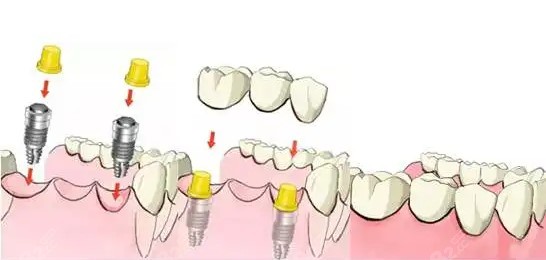 贵阳半全口种植牙价格 贵阳半全口种植牙价格