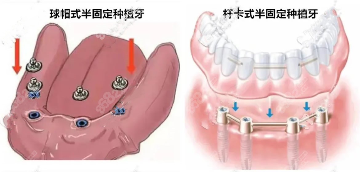 全口半固定种植牙怎么样