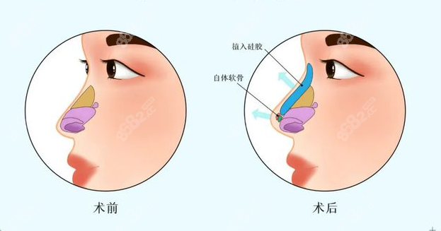 8682网<!--<i data=20240705-sp></i>-->医疗美容鼻修复前后对比图