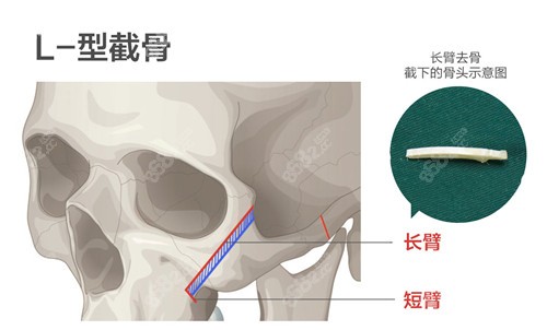 武汉五洲整形颧骨内推手术技术