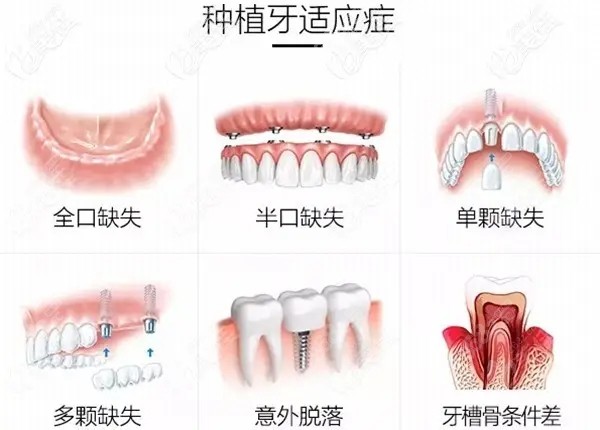 深圳正夫口腔半口牙种植价格：2万元起