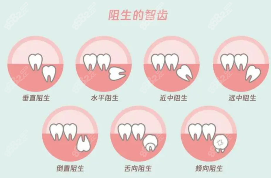 拔智齿