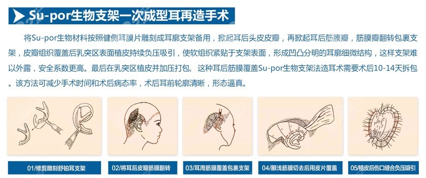 舒鉑生物支架耳再造手術(shù)過程