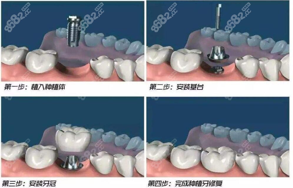 青岛牙博士口腔种植牙示意图