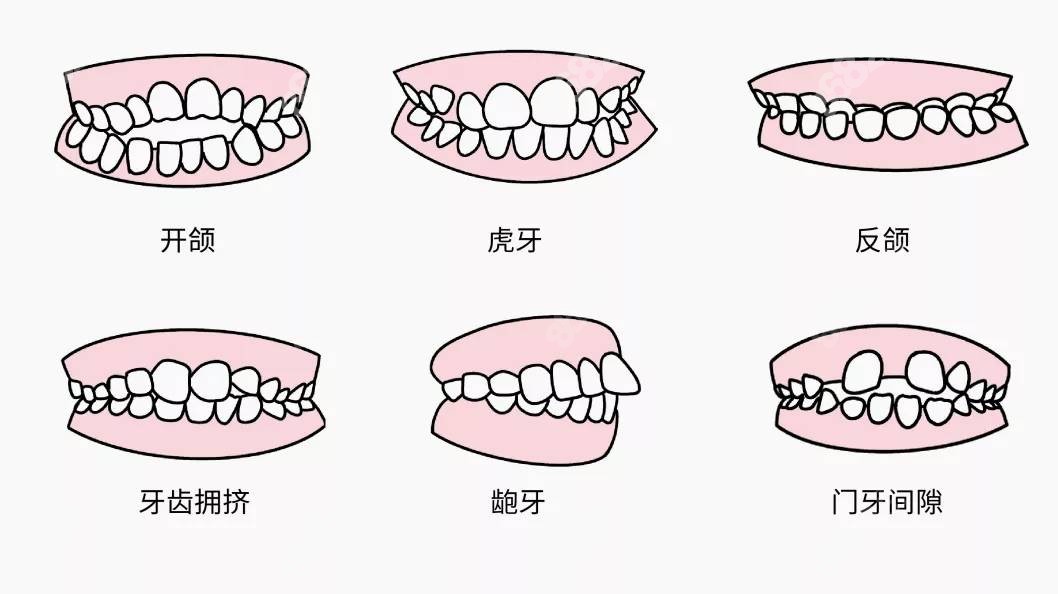 福州贝臣口腔儿牙矫治类型