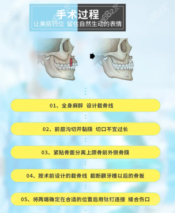 上海时光颌面手术过程