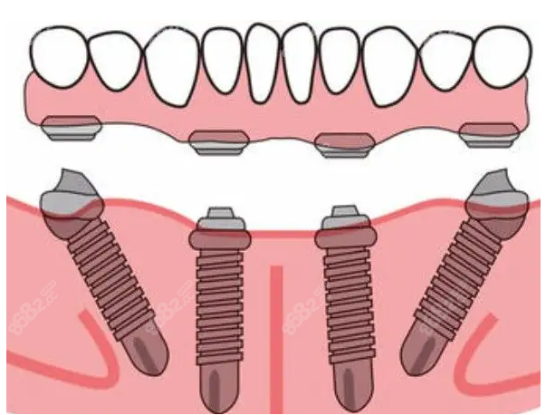 南宁牙百年口腔做all-on-4种植技术图片