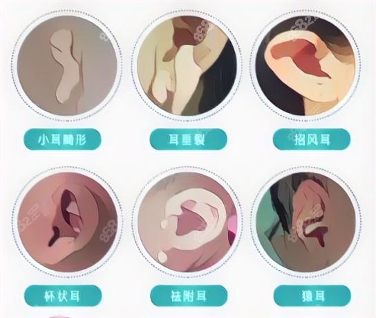 耳廓再造适应症状