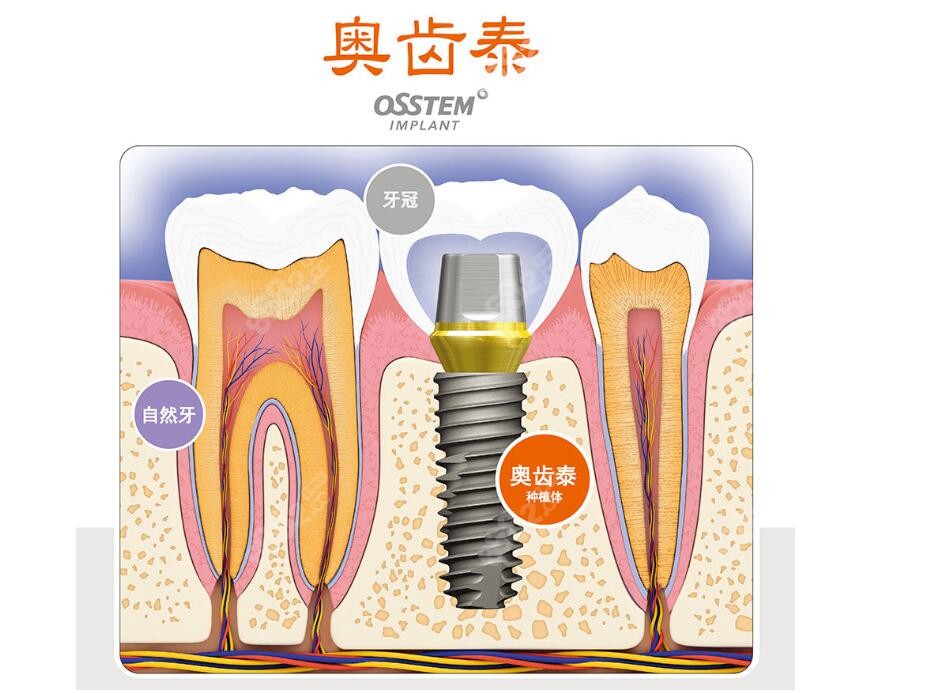 奥齿泰种植体动画图m.8682.cc