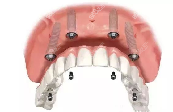 济宁壹颗牙口腔种植牙示意图
