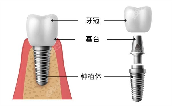 什么是种植牙，种植牙的组成了解下