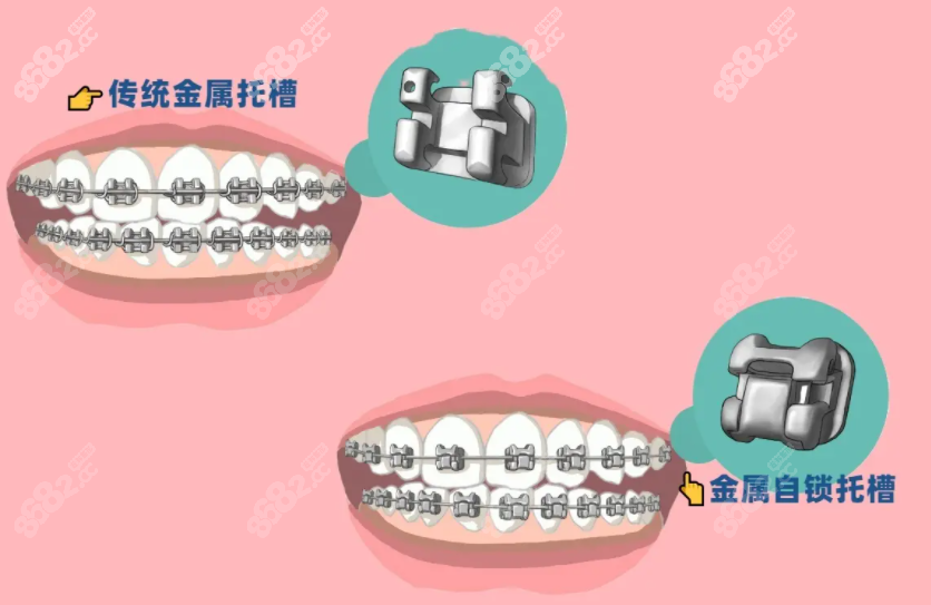 合川口腔医院做金属自锁牙齿矫正的价格