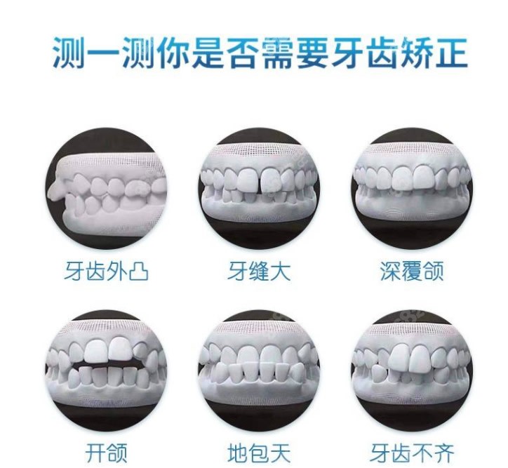 合肥牙齿矫正费用一览表