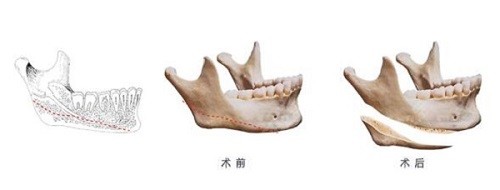 金柱翰下颌角截骨术式