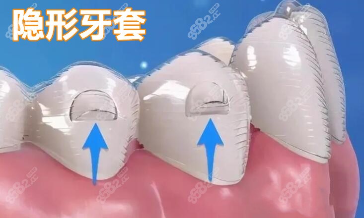 长沙成人牙齿矫正价格