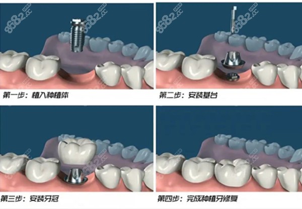 种植牙的过程图