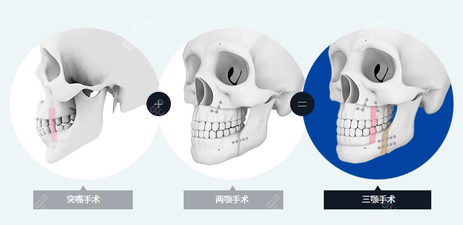 杭州做正颌手术价格大概多少钱