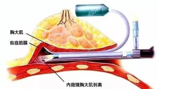 上海美莱王瑾假体隆胸技术采用内窥镜隆胸术