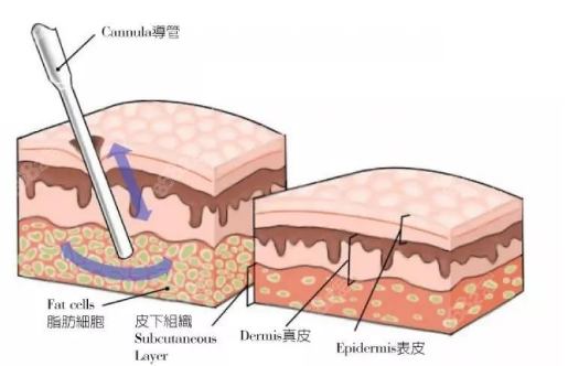 负压吸脂