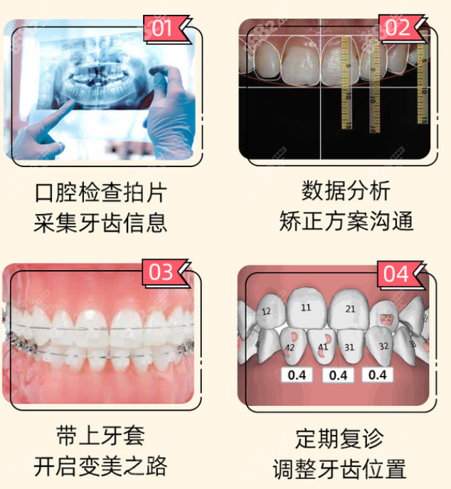 东莞南城区做牙齿矫正过程