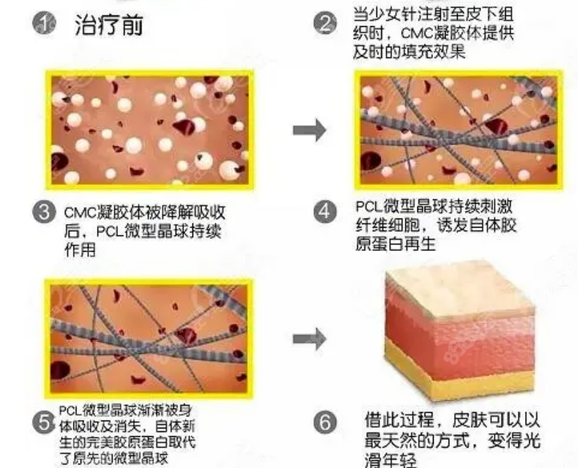 注射少女针伊妍仕