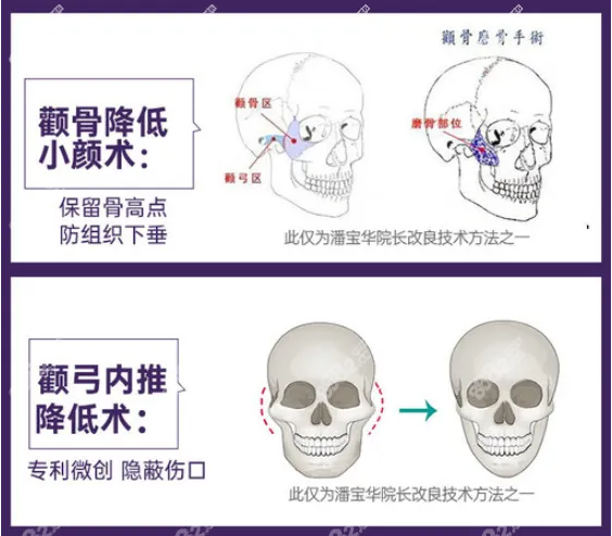 重庆华美颧骨手术优势