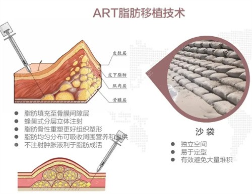 北京上上相做自体脂肪填充出名吗？