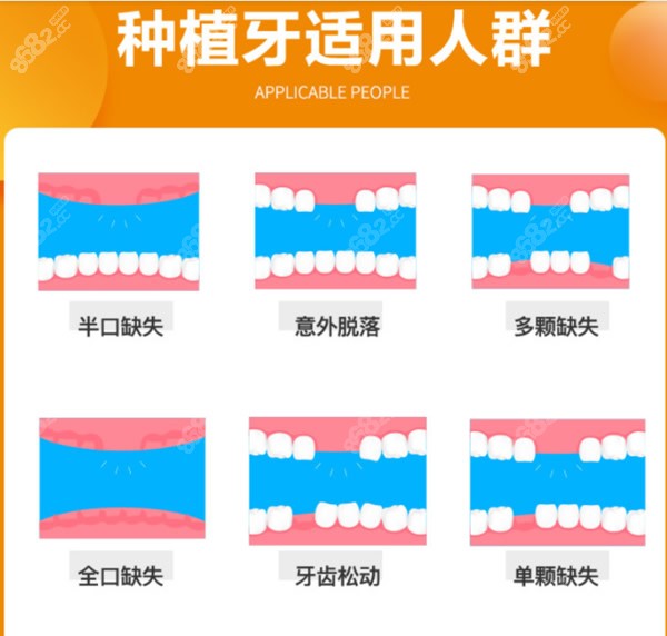 种植牙适合人群