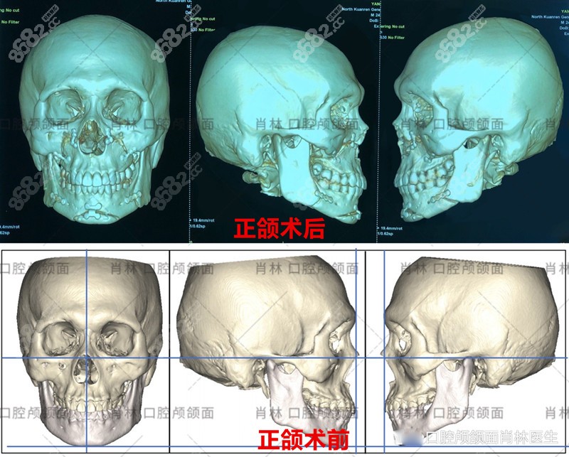 重庆北部宽仁医院肖林正颌直术实例多