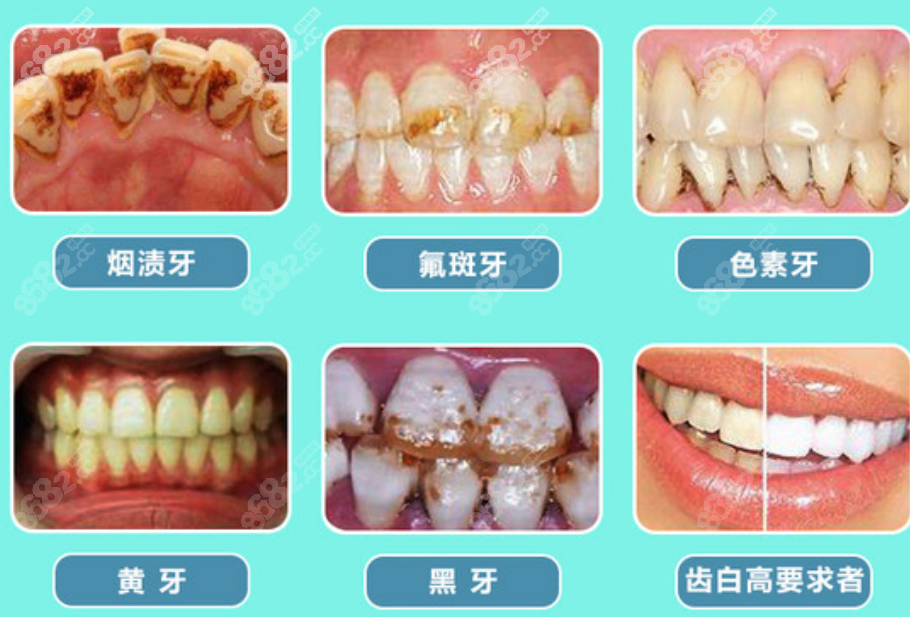 牙齿美白价格大概多少左右