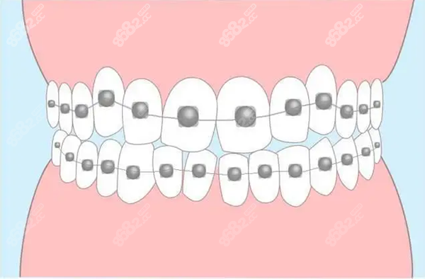 福州维乐口腔矫正价格