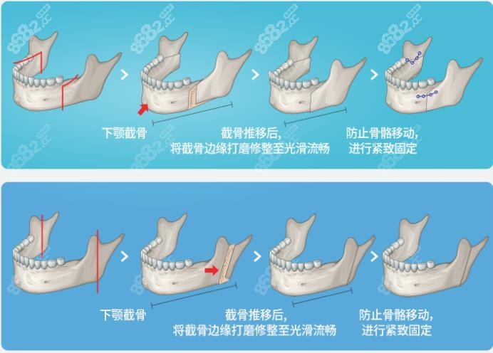 单纯下颚手术的方式示意