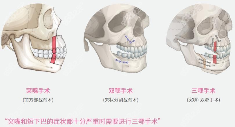 正颌手术的三种方式