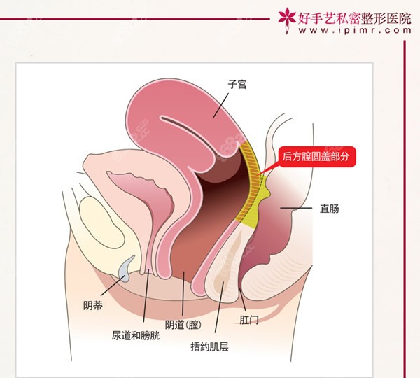 后方膣圆盖缩阴手术怎么样