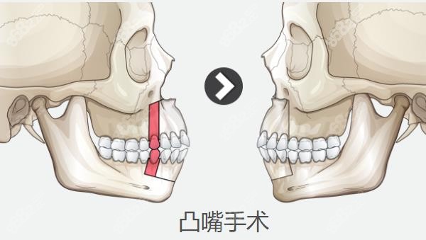 凸嘴手术示意图