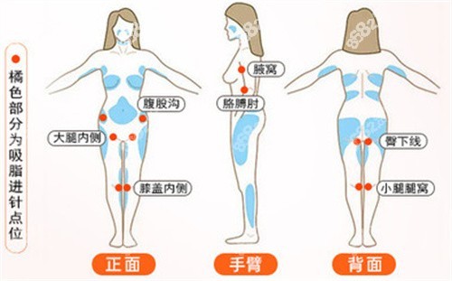 苏州美贝尔吸脂是什么技术