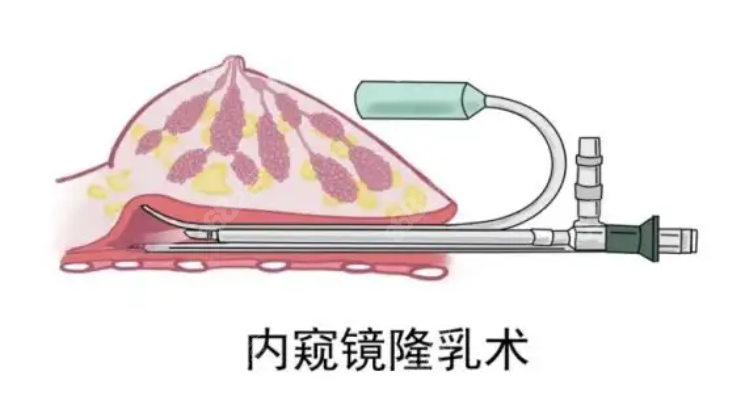 珠海九龙内窥镜假体隆胸技术