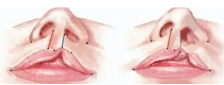 国内唇裂鼻畸形修复类型