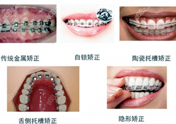 不同类型的牙齿矫正器的图片