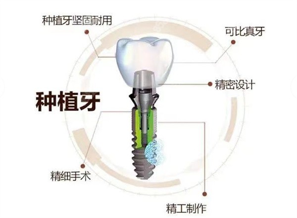 种植牙的优势了解下