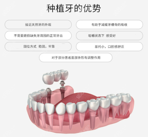 兰州皓亚口腔种植牙怎么样